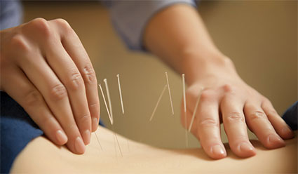Acupuncture Treatment In Blaine, MN