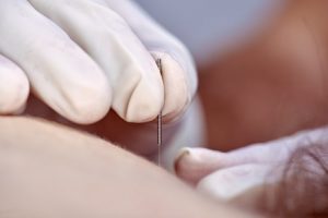 Experienced Acupuncturist in Blaine