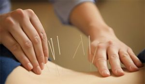 Pain Relieving Acupuncture Treatment